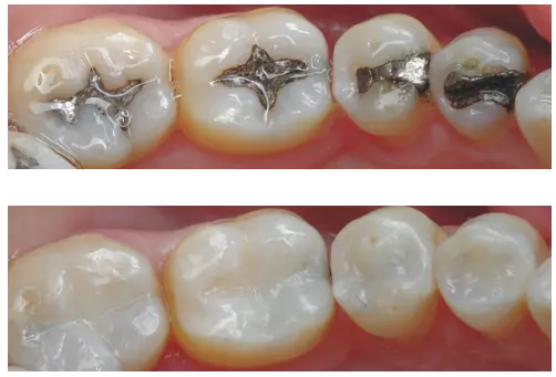 composite fillings at harrisburg dental practice