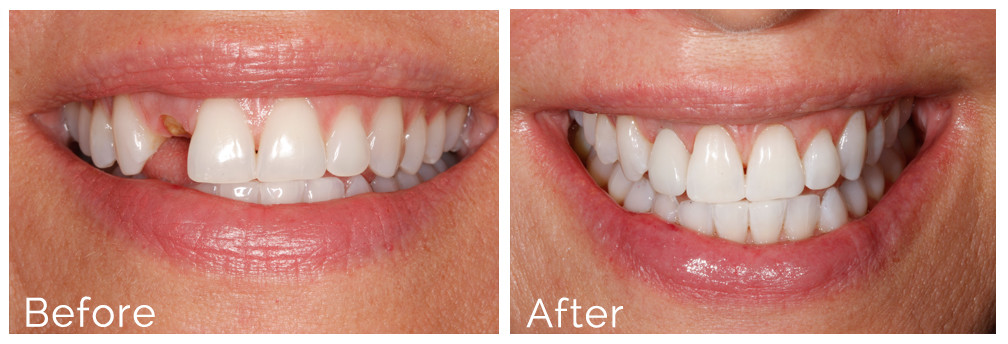 Professional Teeth Whitening