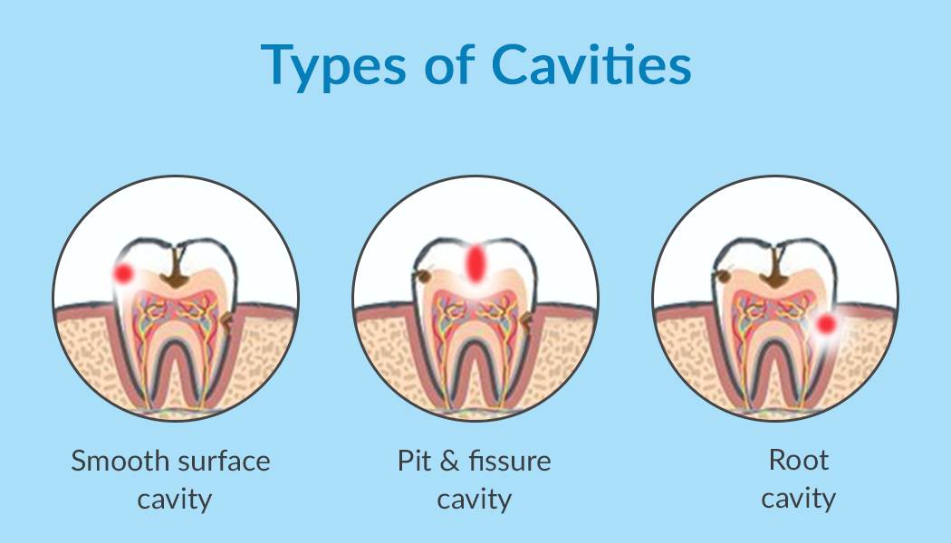 i-was-told-it-is-much-easier-to-get-dental-cavities-with-braces-on