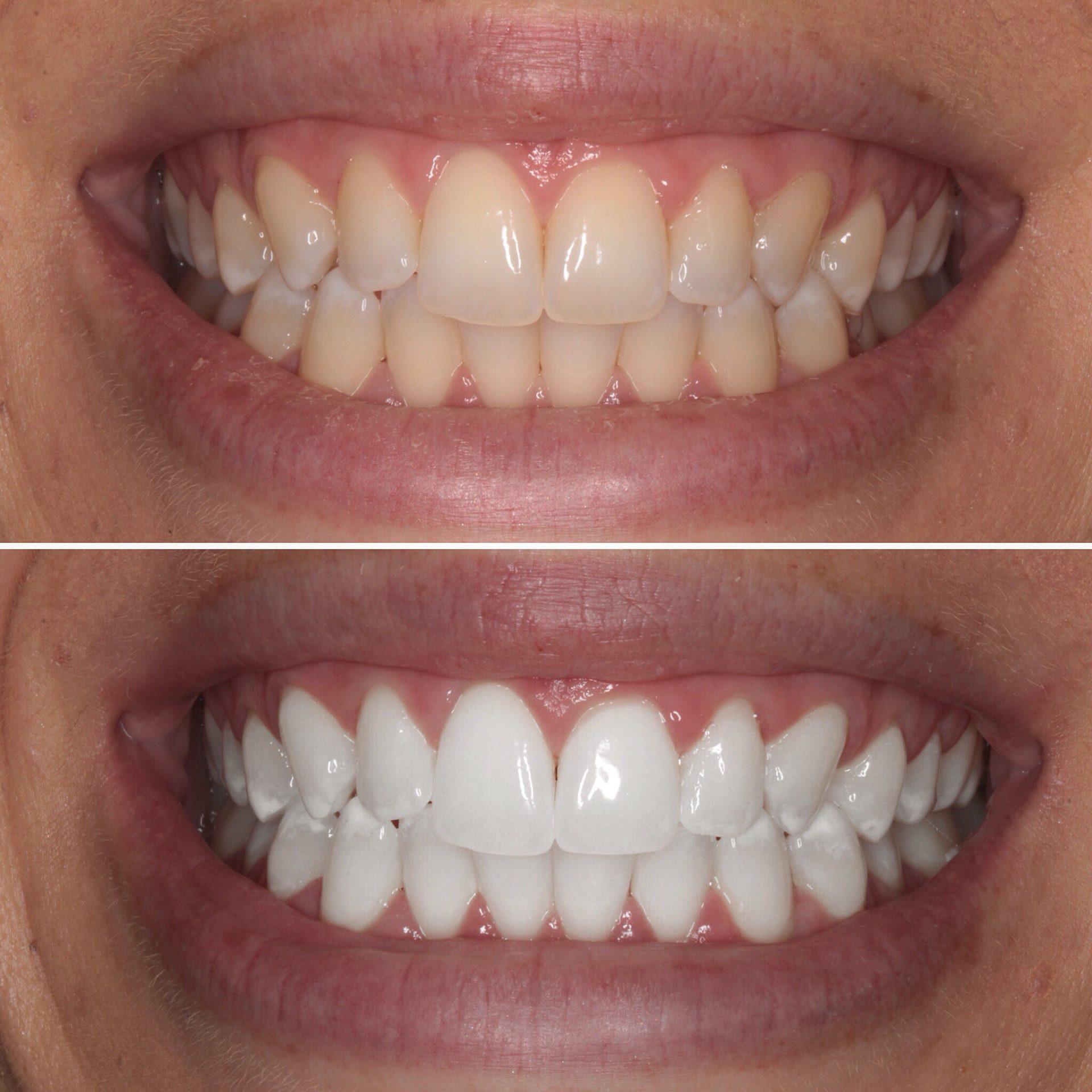 Teeth Whitening London