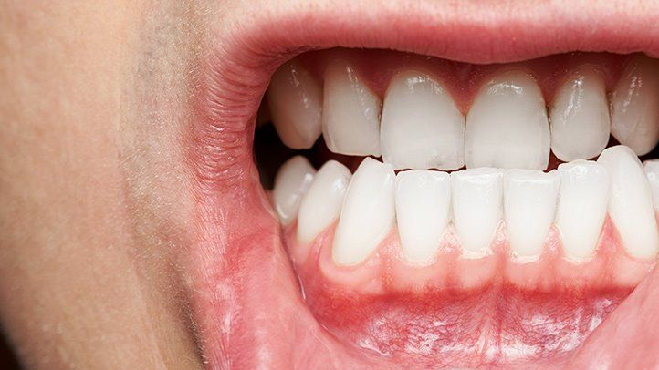 Gum Disease: Gum Surgery Explained