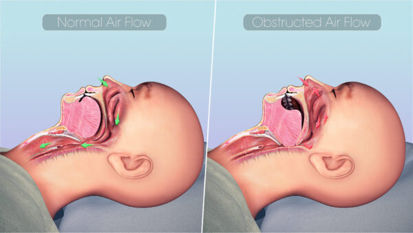 treating sleep apnea restricted airflow AT DENTIST Harrisburg NC 