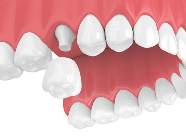 Don't Wait! Repair Damaged Teeth With CEREC Same-Day Dental Crowns