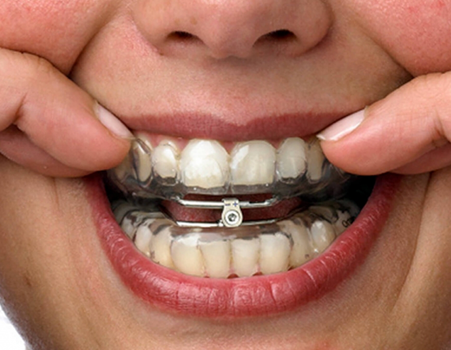 Some Commonly Asked Questions About Oral Appliance Therapy