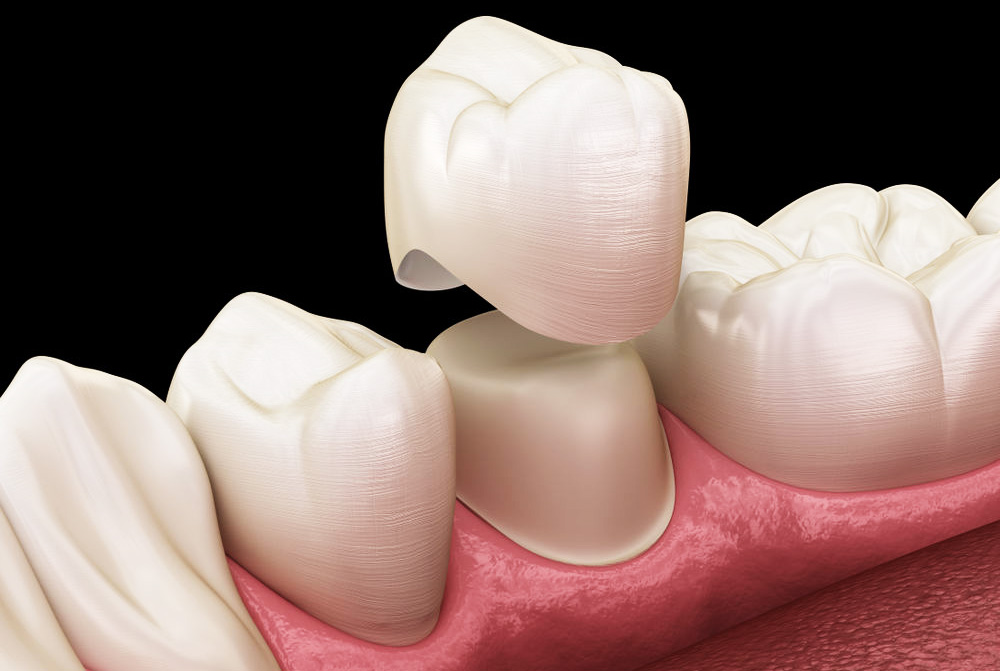 Amazing Benefits of CEREC Crowns - Icard & Strein