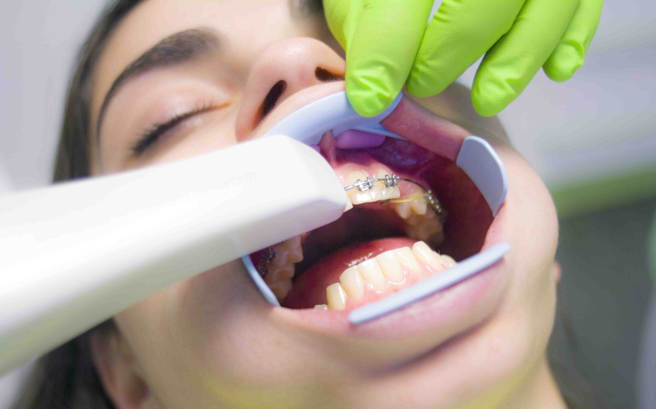 Orthodontic Treatments Types & Benefits - Icard & Strein Family Dentistry