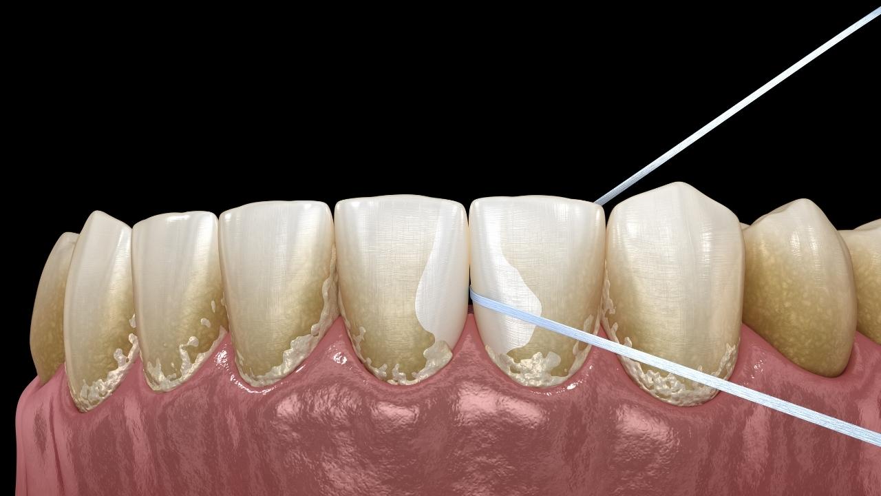 Poor Oral Hygiene Causes - Icard & Strein Family Dentistry