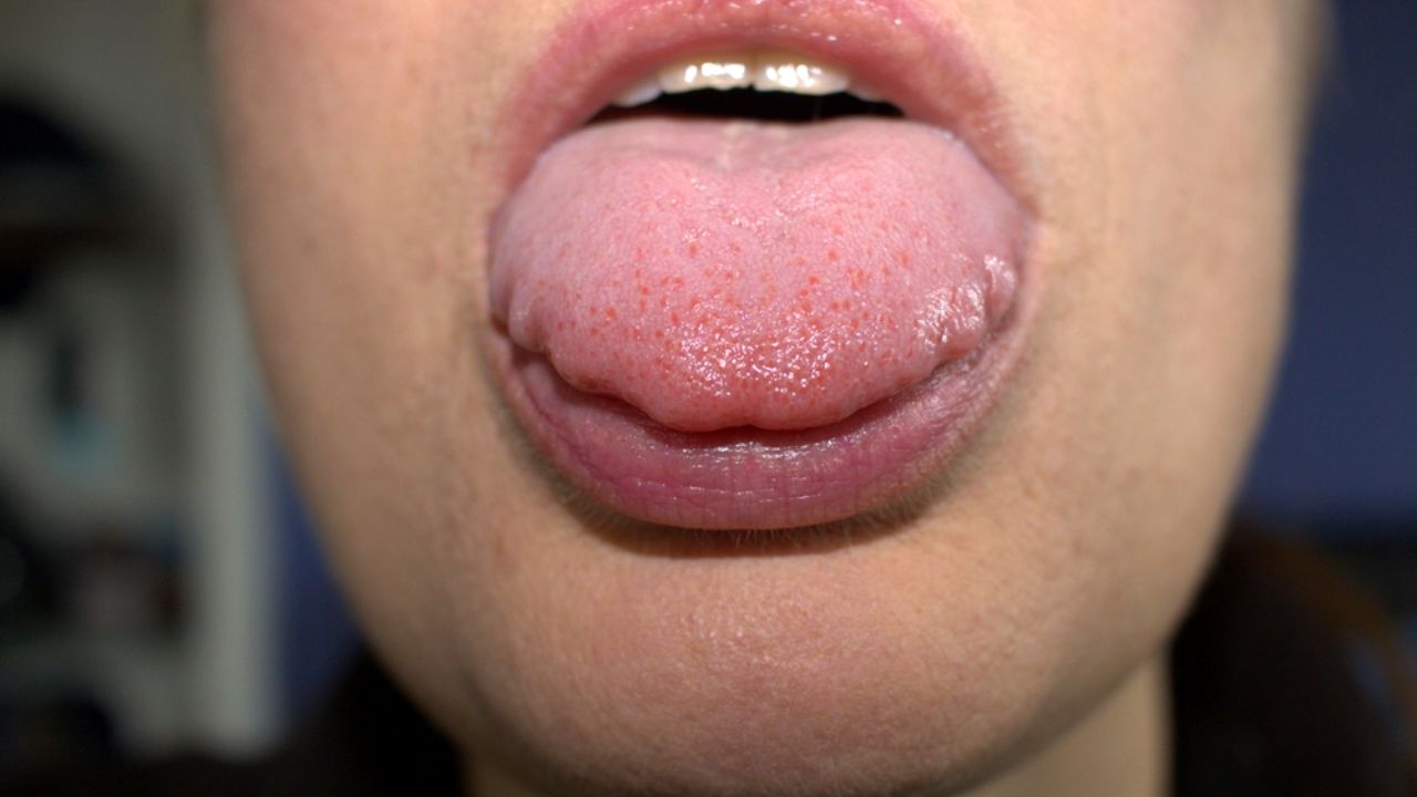 Scalloped Tongue Everything You Need To Know Icard And Strein 