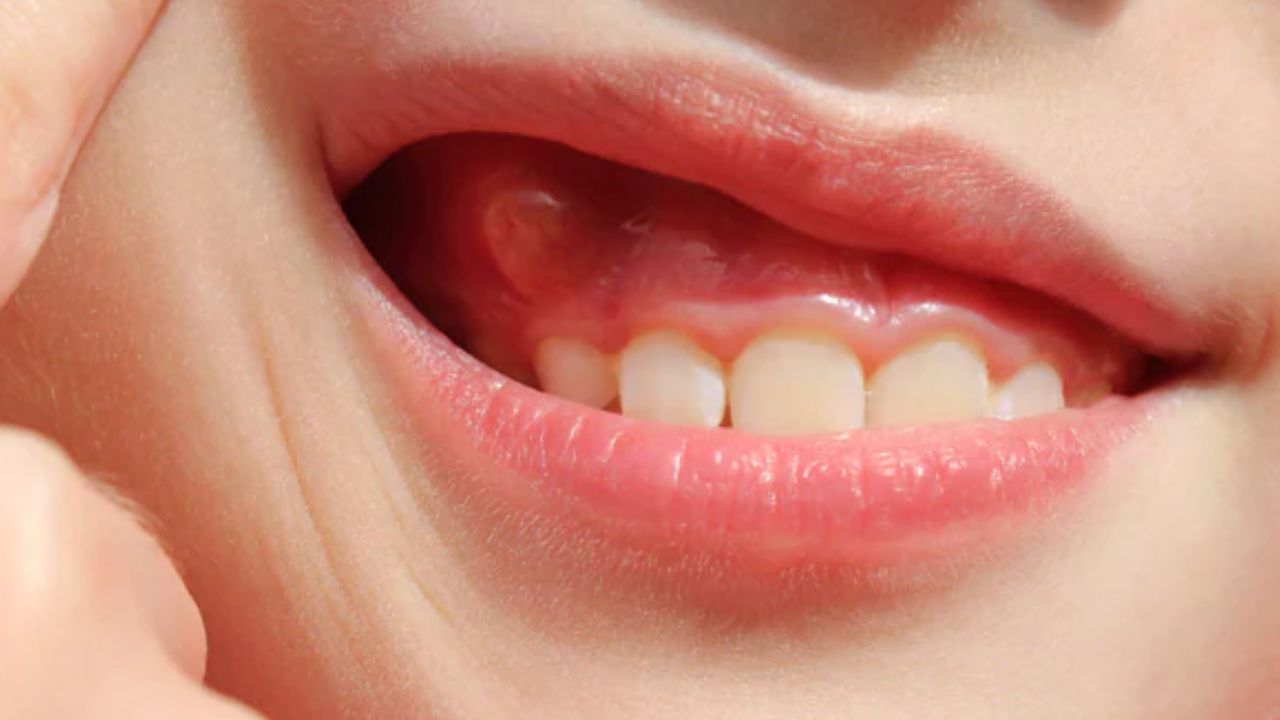 White Bumps On Gums