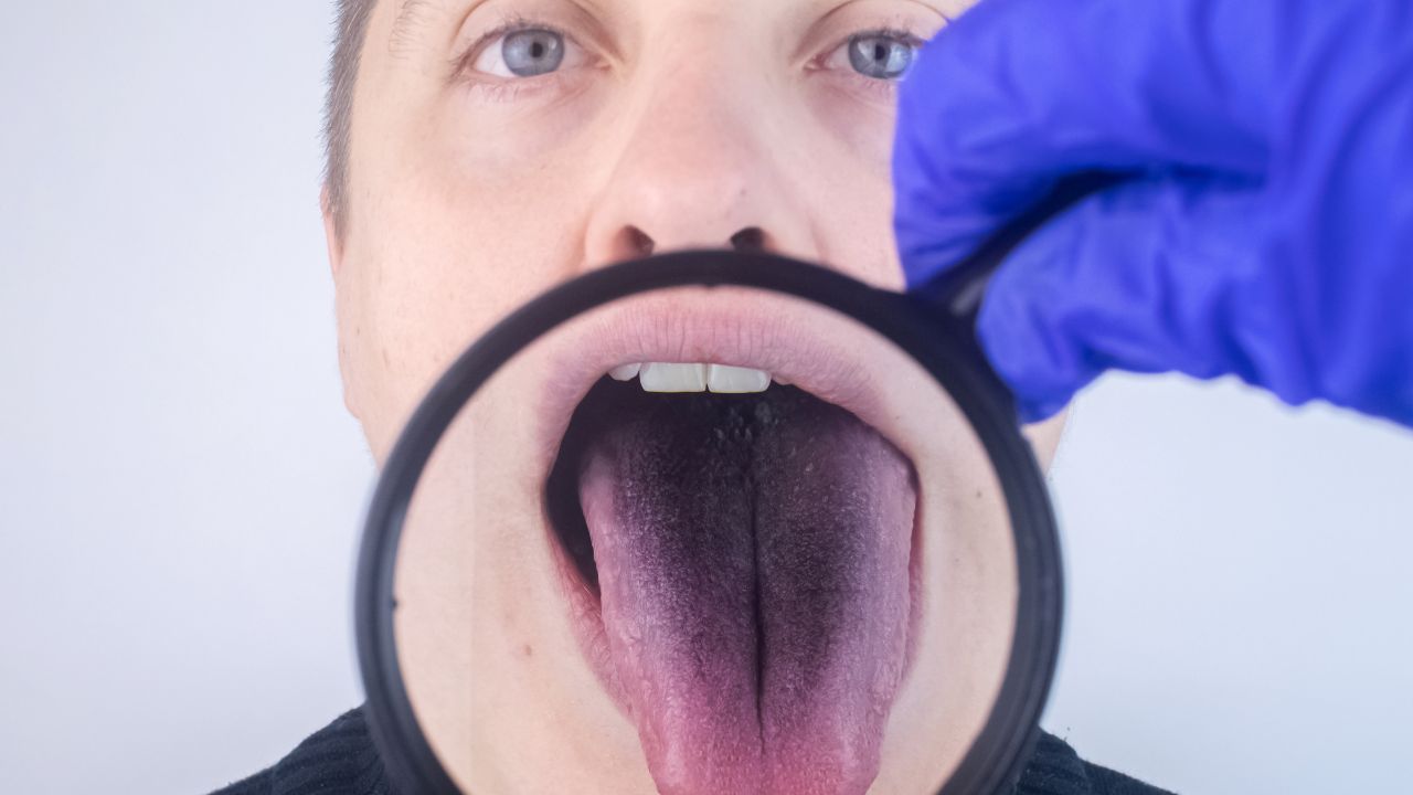 Why Is My Tongue Purple - Causes Explained - Icard