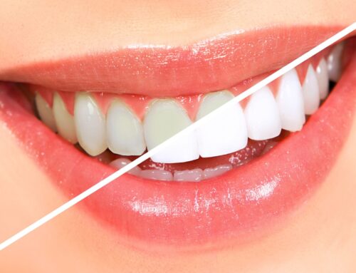 Professional Teeth Whitening Options?