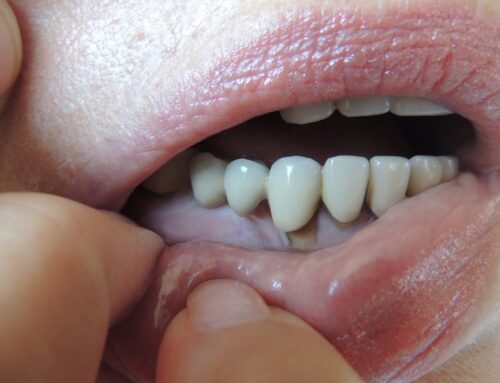 Orthodontics and Severe Stage IV Periodontitis: What Patients Need to Know